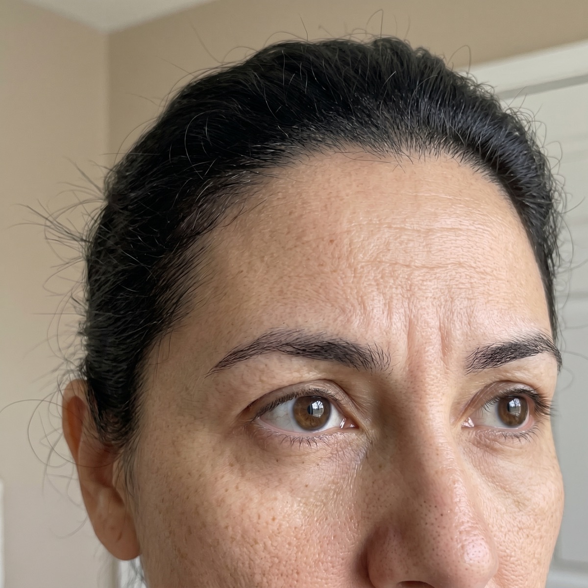 Resultado natural después de Botox para frente y expresión facial