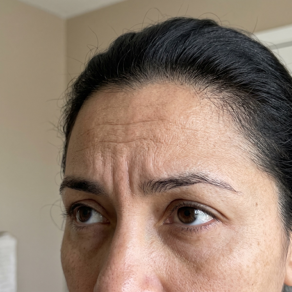 Valoración antes de tratamiento antiarrugas con Botox en Puebla