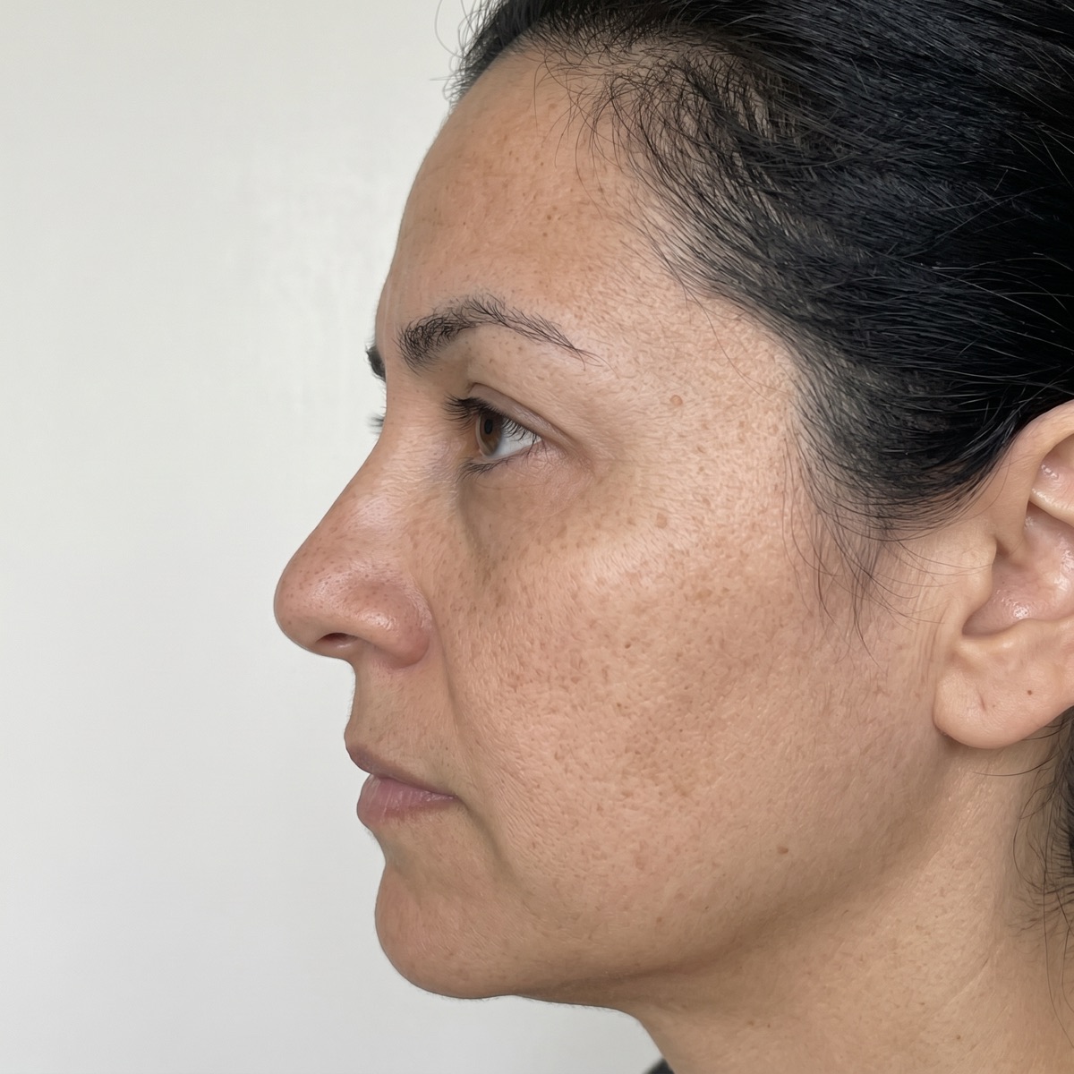 Perfil nasal antes de rinomodelación en Puebla